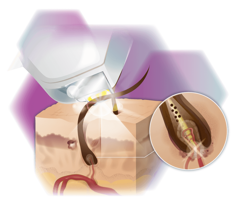 graphic ND:YAG laser mode of action